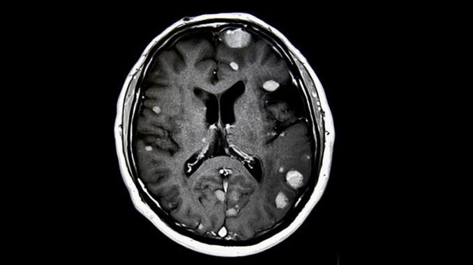 Overcoming-Resistance-to-Radiotherapy-for-Brain-Metastases.jpg
