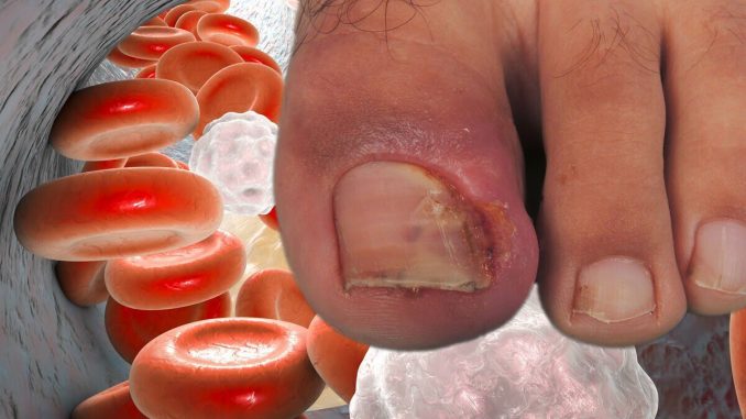High-cholesterol-may-cause-two-nail-changes-that-could-become-‘serious-concerns-warning.jpg