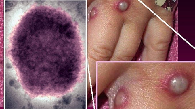 Monkeypox-symptoms-full-list-What-to-look-out-for-as-UKHSA-identifies-four-new-cases.jpg