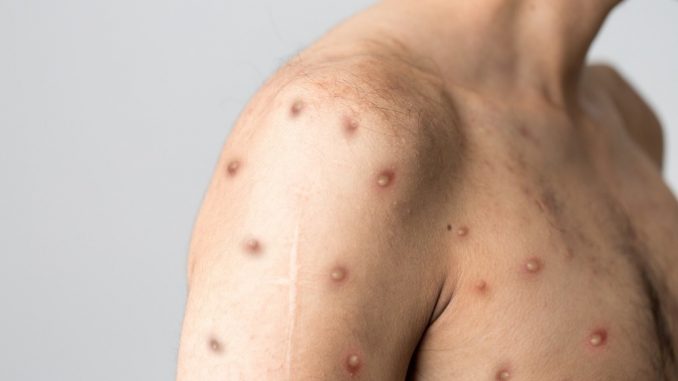 CDC-report-shows-people-with-monkeypox-have-higher-than-expected-rates-of-HIV-and-STIs.jpg