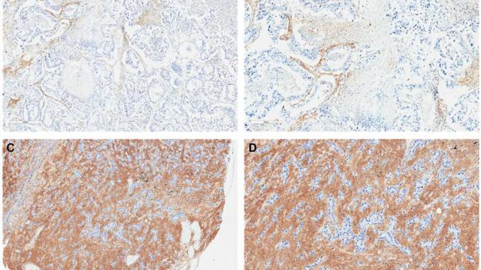 Tumor-hyaluronan-as-a-novel-biomarker-in-non-small-cell-lung-cancer-A-retrospective-study.jpg