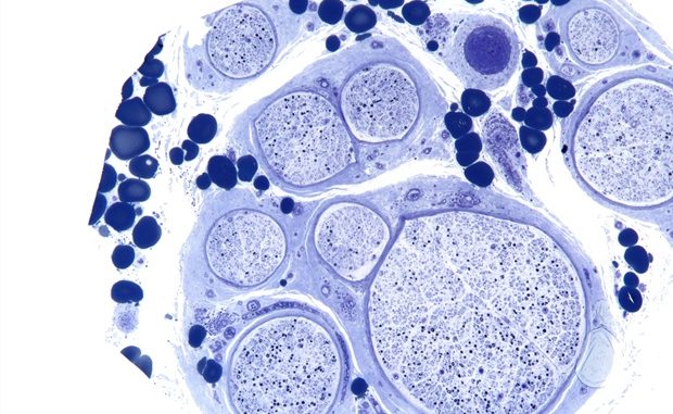 New-robotic-bronchoscopy-may-be-safer-and-more-effective-way-to-perform-lung-nodule-biopsies.jpg