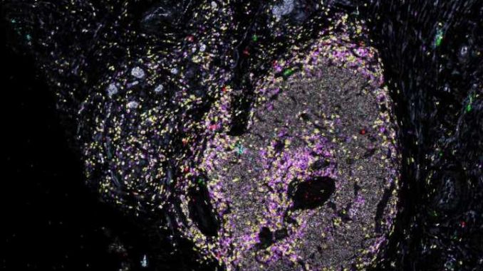 Keys-to-making-immunotherapy-work-against-pancreatic-cancer-found-in-tumor-microenvironment.jpg