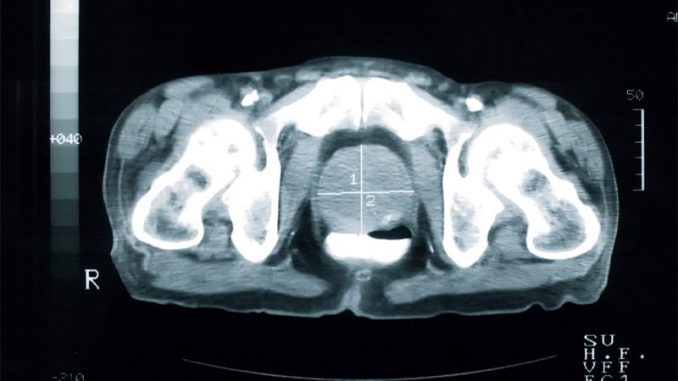 Many-With-Prostate-Cancer-Have-Vertebral-Fracture-at-ADT-Onset.jpg