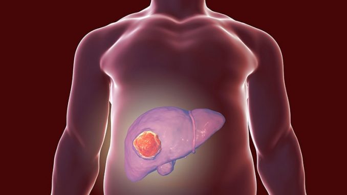 Sex-Differences-in-HBV-Associated-Liver-Cancer.jpg