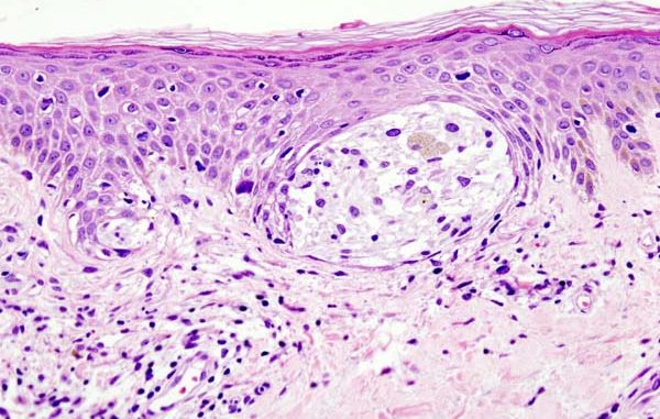 Using-a-seaweed-sugar-to-trigger-immune-responses-that-suppress-melanomas.jpg