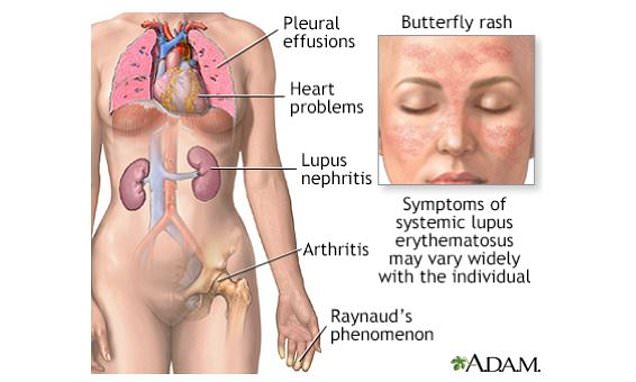 What-is-lupus-The-disorder-that-causes-the-body-to-attack-itself.jpg