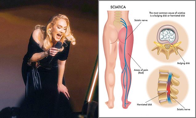 What-is-sciatica-Adeles-debilitating-back-pain-condition-revealed.jpg