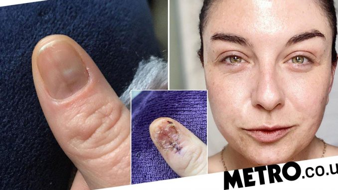 039A-beauty-therapist-noticed-a-039bruise039-on-my-nail-she-saved-my-life039.jpg