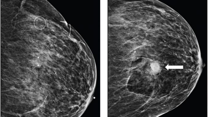 Bleeding-after-image-guided-breast-biopsies-Discontinuing-vs.-maintaining-antithrombotic-therapy.jpg
