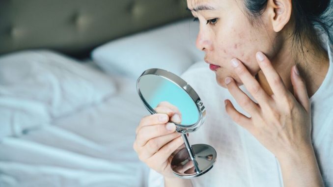 Cheap-high-blood-pressure-drug-could-help-clear-up-adult-acne-new-study.jpg