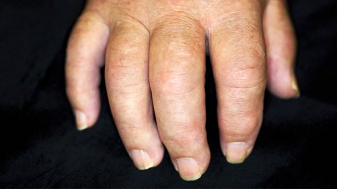EULAR-PsA-Update-Emphasizes-Safety-Non-MSK-Manifestations.jpg