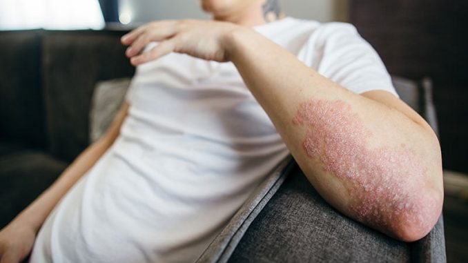 FDA-Decision-on-Bimekizumab-Approval-for-Psoriasis-Delayed.jpg