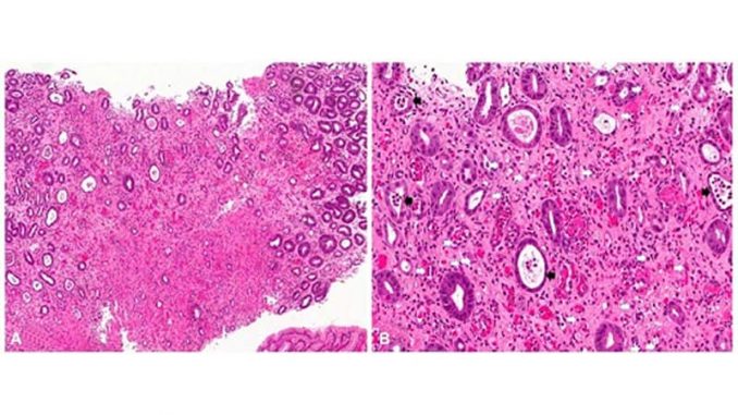 Mixed-Results-for-Drug-in-Eosinophilic-Gastritis.jpg