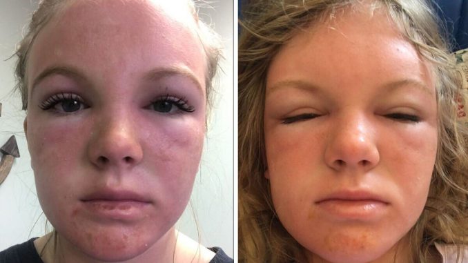 Womans-warning-after-horrific-sunburn-left-her-face-looking-like-an-alien.jpg