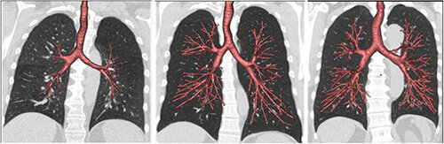 Early-life-lung-development-has-an-impact-on-the-risk-of-premature-death-study-suggests.jpg
