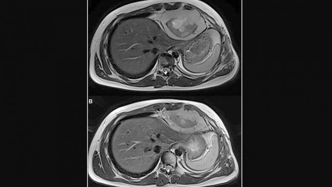 Researchers-report-on-intrathoracic-synovial-sarcoma-with-BRAF-V600E-mutation.jpg