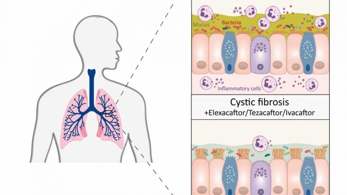 Triple-combination-therapy-brings-lasting-improvement-in-cystic-fibrosis-shows-study.jpg